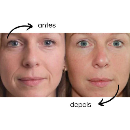 Patch Renew - Adesivos de Silicone Reutilizável Anti Rugas e Linhas de Expressão