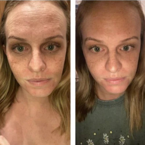 Patch Renew - Adesivos de Silicone Reutilizável Anti Rugas e Linhas de Expressão